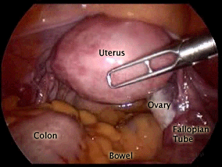 Endoscopic pelvis